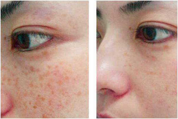 تصویر قبل و بعد از استفاده از محصولات فوراور